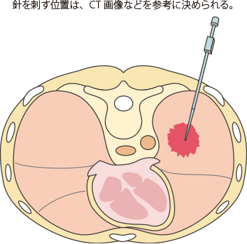 皮膚の上から針を刺して肺の細胞をとる 肺がん検査のさまざまな方法 肺がんとともに生きる