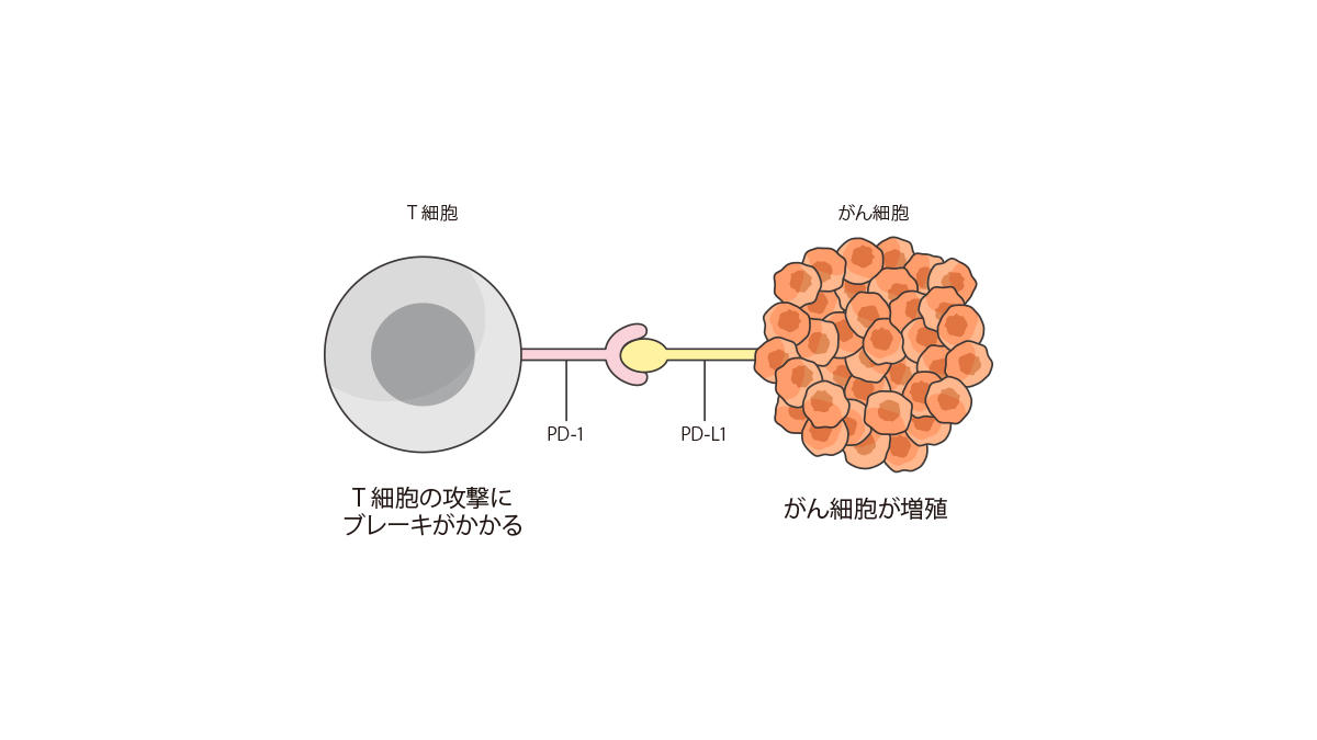 免疫療法のために行うpd L1検査 ご自身の肺がんに合う薬剤を選ぶための情報を得る 肺がんとともに生きる