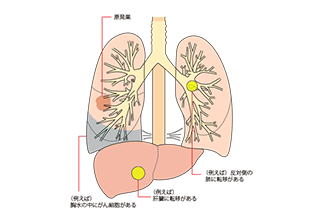 Iv期 ステージ4 の肺がん 転移性肺がん Tnmで病期は決まる 肺がんとともに生きる